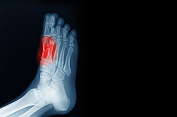 Shoe inserts sales for sesamoiditis
