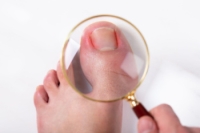 Causes and Symptoms of Ingrown Toenails