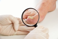 How Is Toenail Fungus Treated?