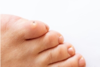 Common Locations of Corns
