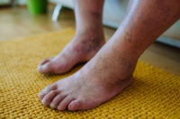 How Physical Activity Improves Diabetic Foot Health