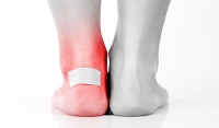 What Should I Do if I Have a Foot Blister?
