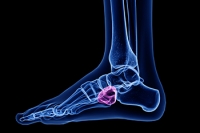 Symptoms of Cuboid Syndrome