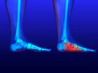 Symptoms and Causes of Flat Foot Pain