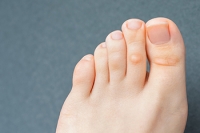 Common Types and Causes for Corns on the Feet