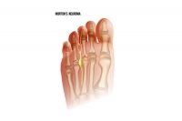 Recognizing the Symptoms of Morton’s Neuroma