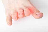 What Is Morton’s Neuroma?