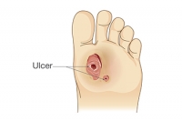 Definition and Causes of Diabetic Foot Ulcers