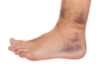 Chronic Ankle Instability