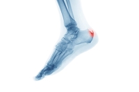 How a Chiropodist Can Help With Heel Spurs