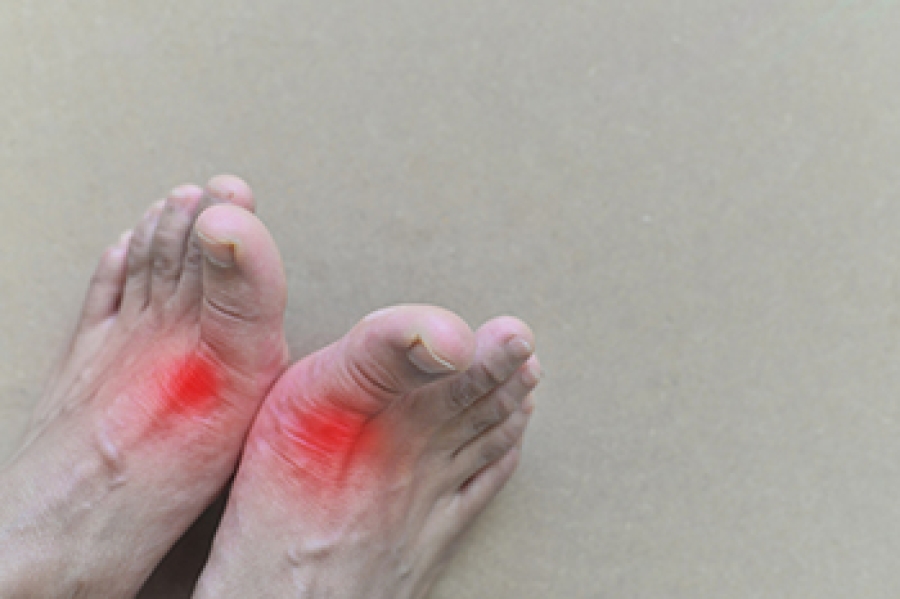 Gout and How It Impacts Feet