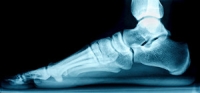 Conditions Potentially Linked to Adult Flat Feet