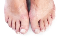 How Psoriatic Arthritis Can Affect the Feet and Ankles
