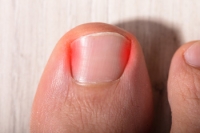Non-surgical Options for Ingrown Toenails