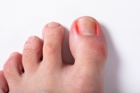 What Causes Ingrown Toenails?