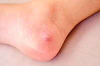 Causes and Signs of Infected Foot Blisters