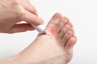 How Athlete’s Foot Is Treated