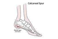 Eating Healthy Foods May Affect a Heel Spur