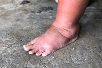 Causes of Swollen Ankles in Seniors