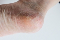Chiropodist’s Help With Cracked Heels