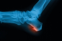 Risk Factors and Symptoms of Heel Spurs
