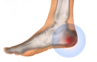 Common Forms of Heel Pain