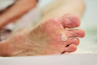 Managing Plantar Warts